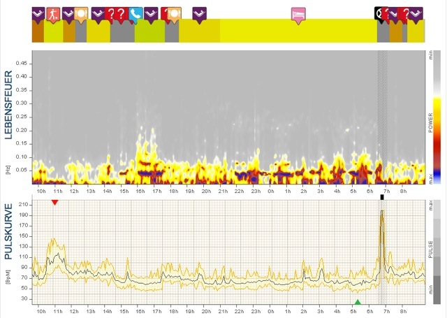 Schlafapnoe Schlafapnoe
